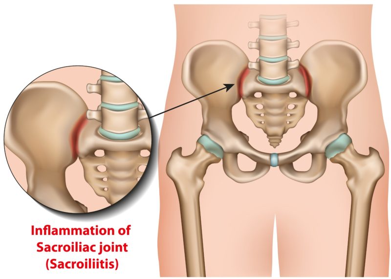 What Is Sacroiliac Joint Dysfunction New Jersey Comprehensive