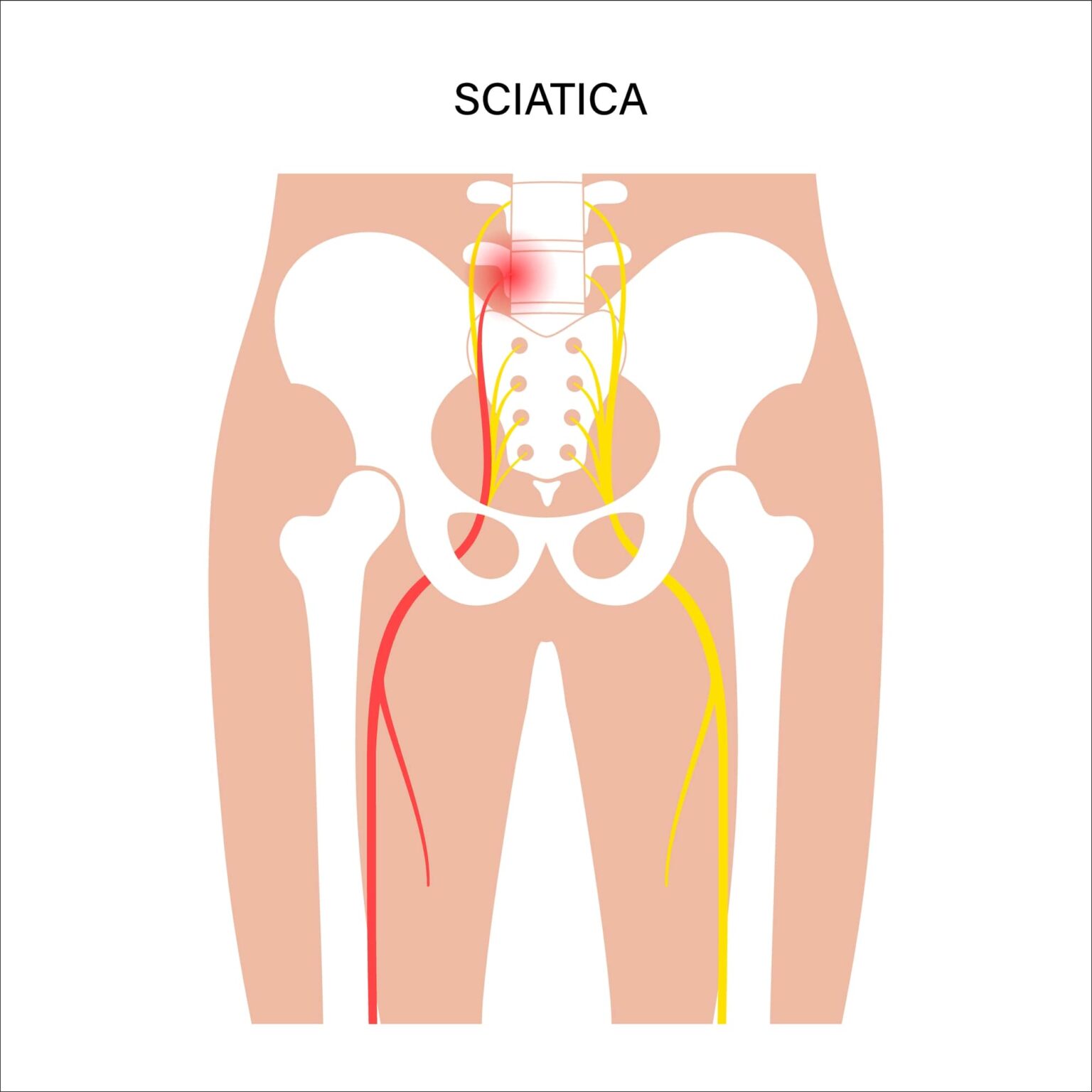 Sacroilitis Vs Sciatica What S The Difference New Jersey Comprehensive Spine Care