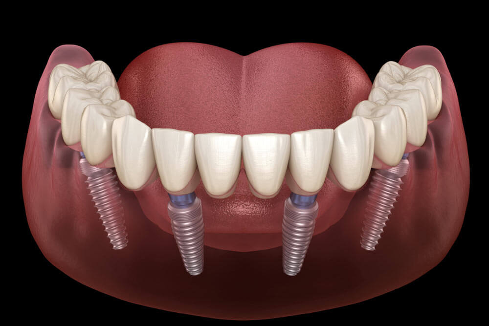All on 4 implant supported dentures showing the concept of Procedures