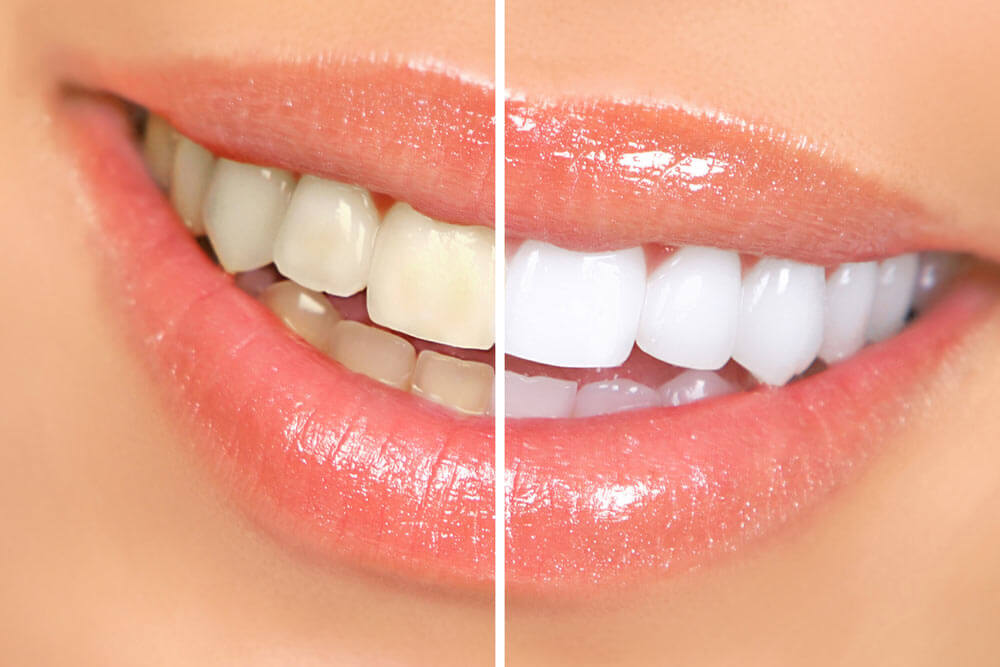 Teeth whitening showing the concept of Cosmetic Dentistry