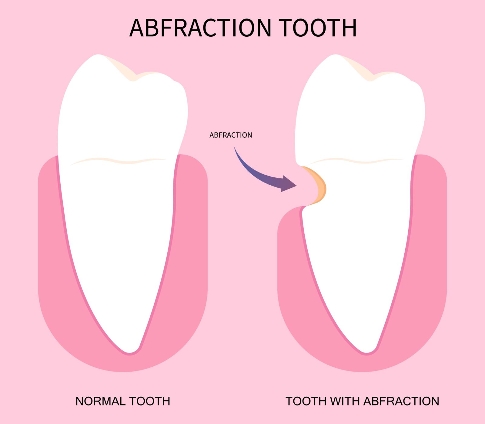 What Is An Abfraction Lesion Altoona IA Altoona Smiles