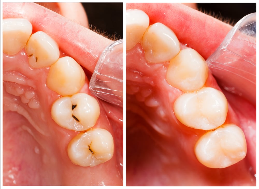 Composite tooth colored fillings