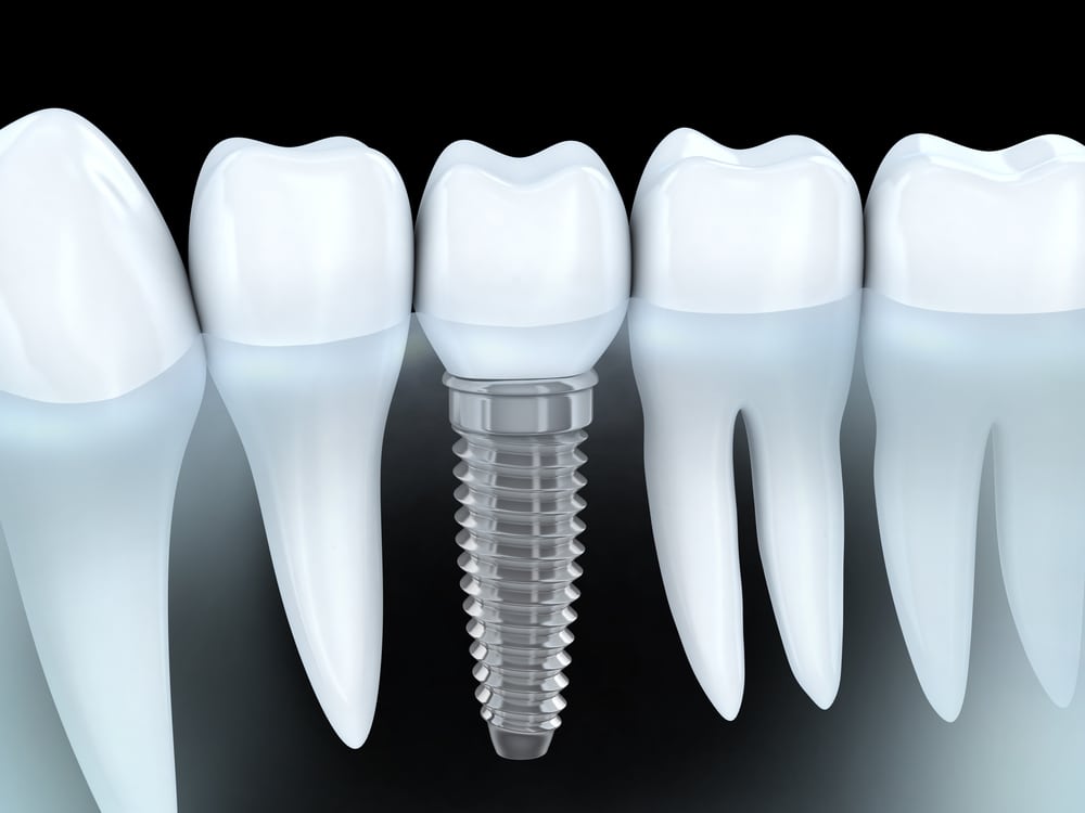 Dental implants