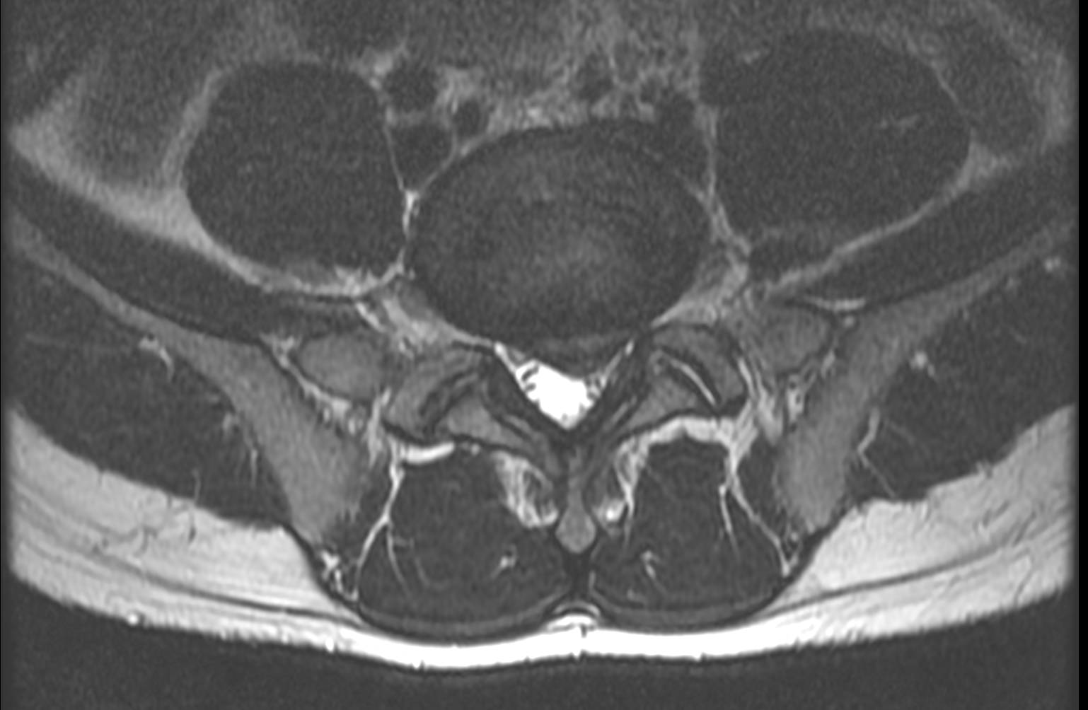 Herniated Disc xray