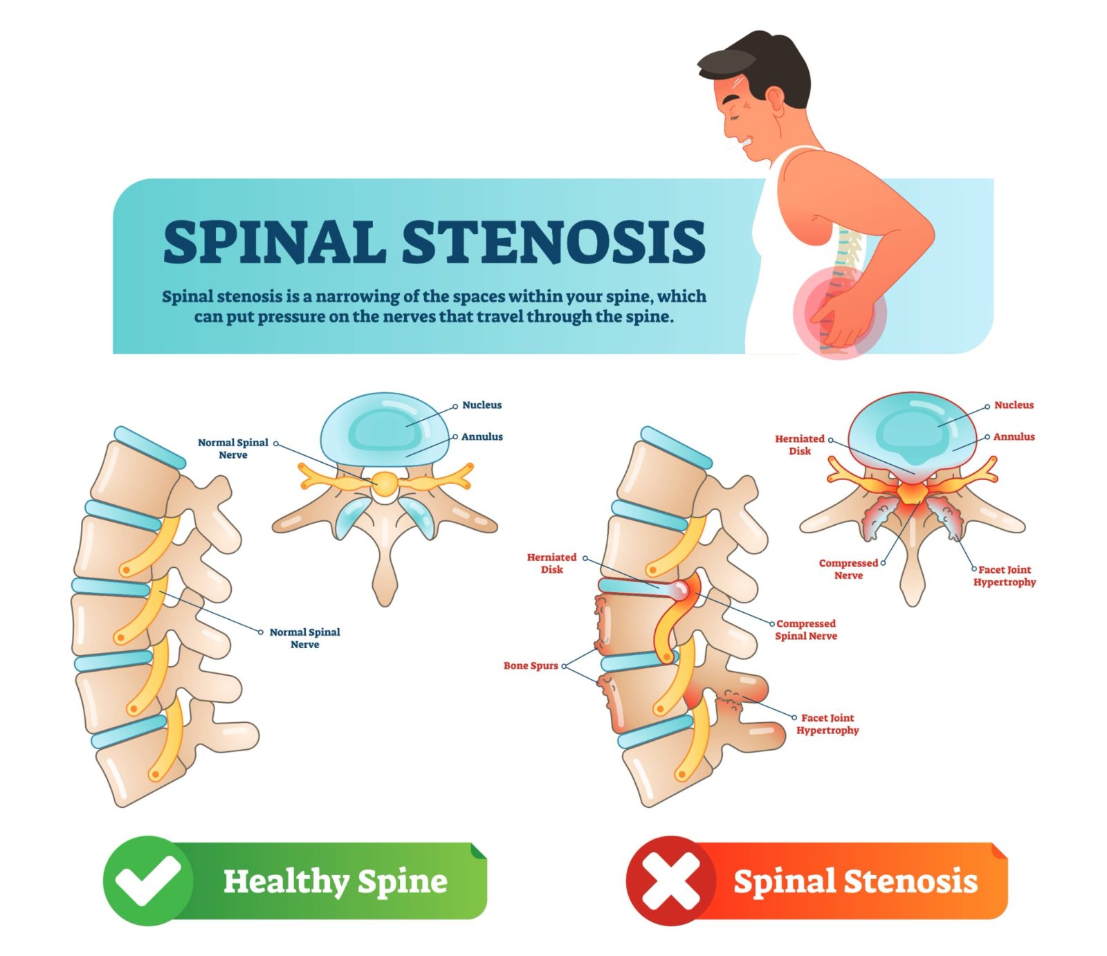 healthy spine vs Spinal Stenosis