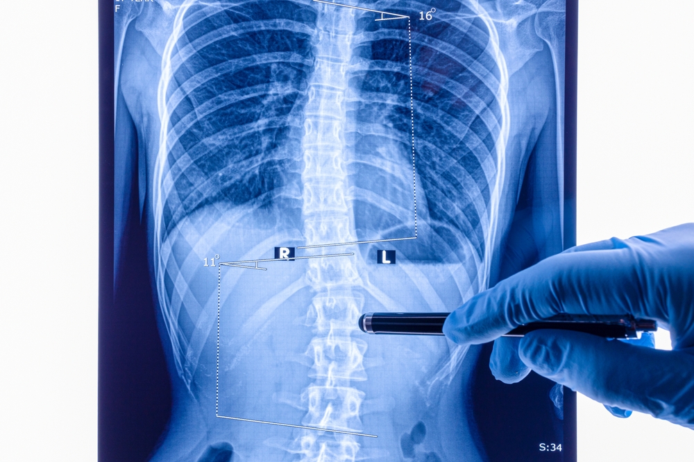 An X-Ray of Scoliosis