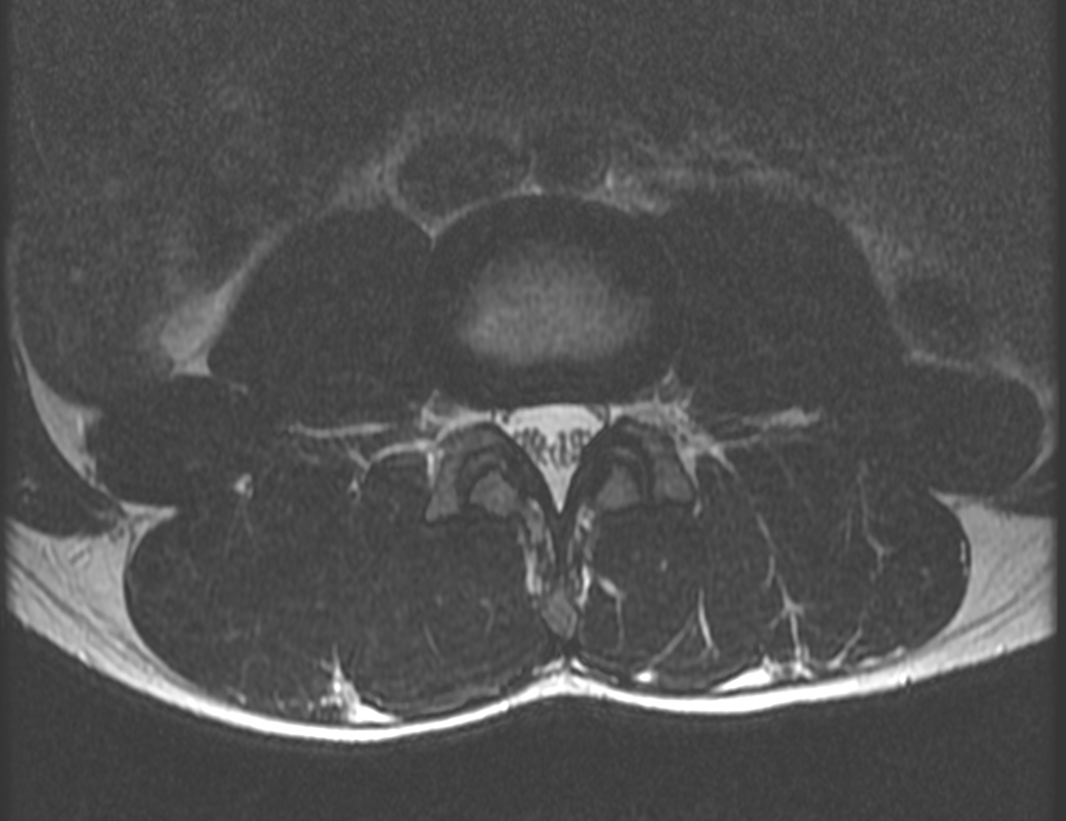 Herniated Disc xray