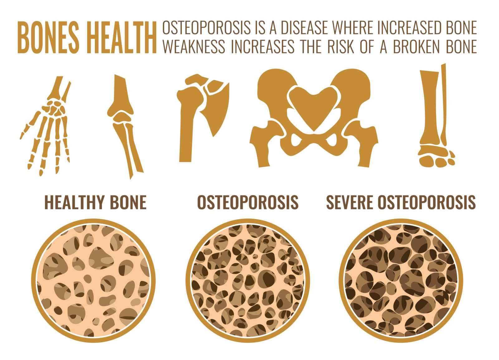 infographic about osteoporosis