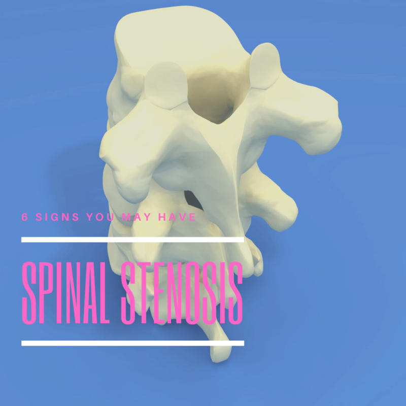 6 Signs You May Have spinal stenosis