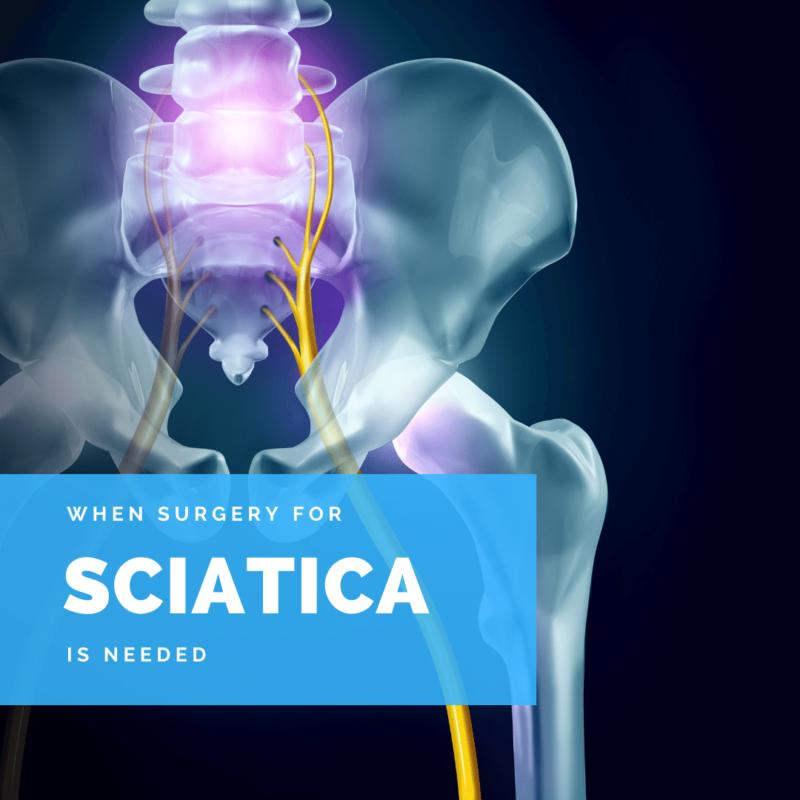 When surgery for sciatica is needed