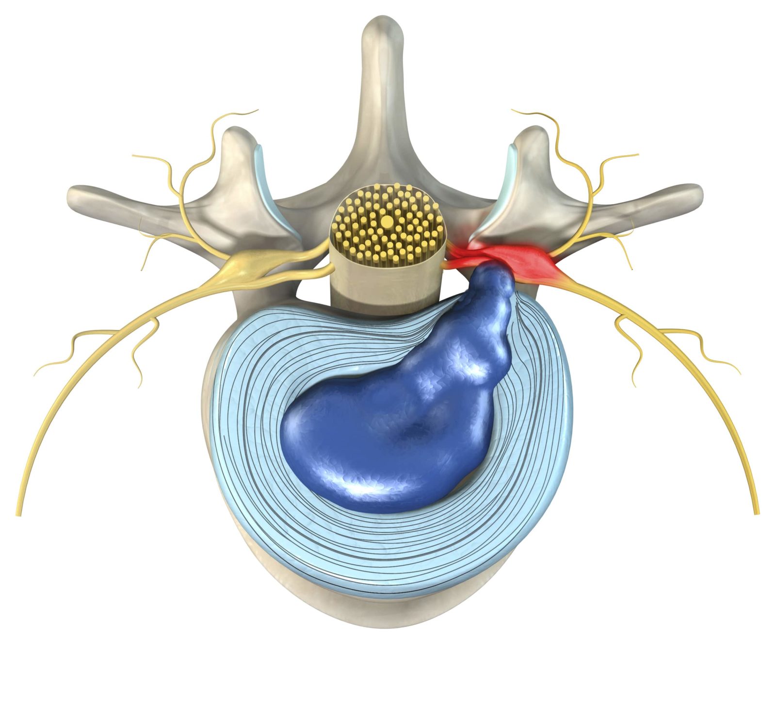 illustration of a slipped disc