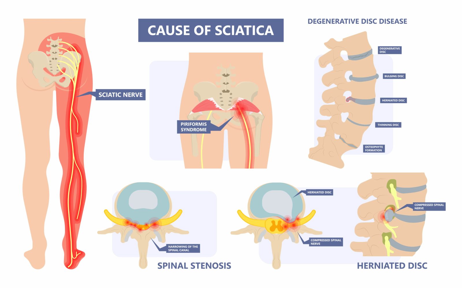 causes of sciatica infographic
