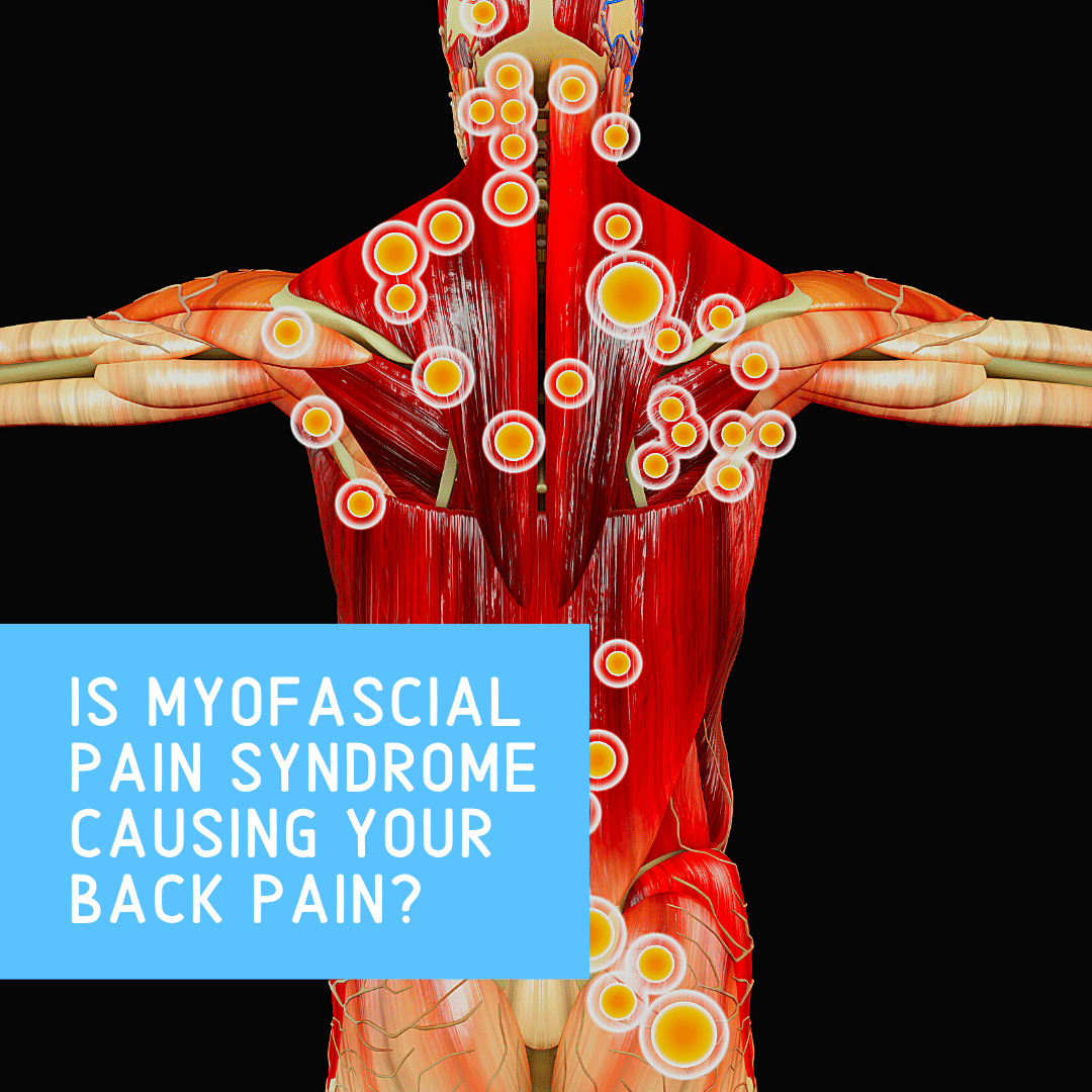 Is Myofascial Pain Syndrome Causing Your Back Pain? | New Jersey ...