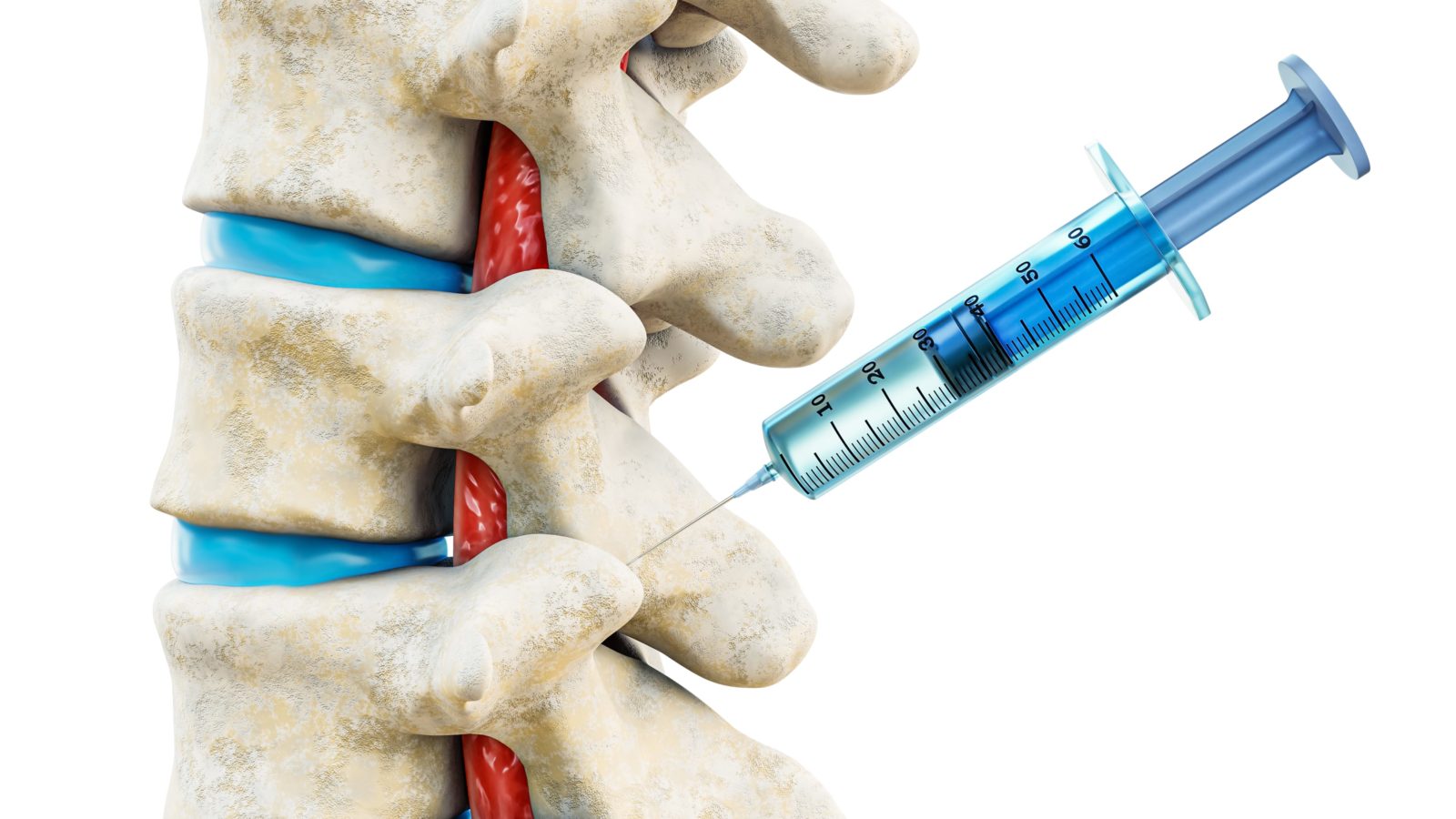 facet joint spinal injection