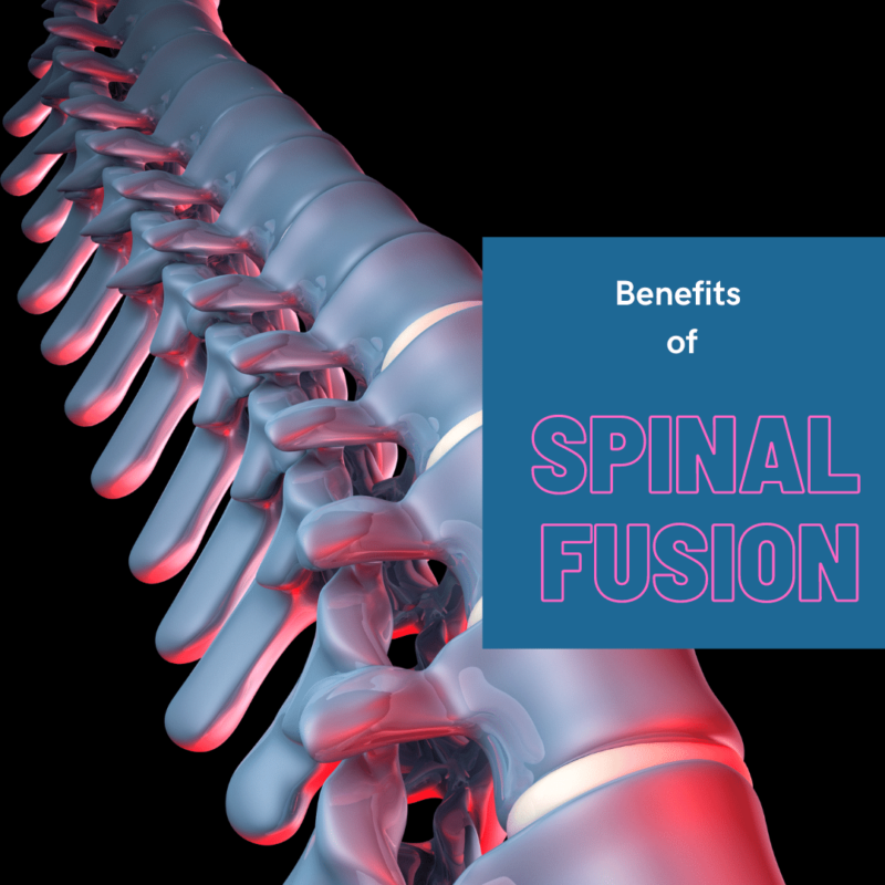 Benefits of spinal fusion