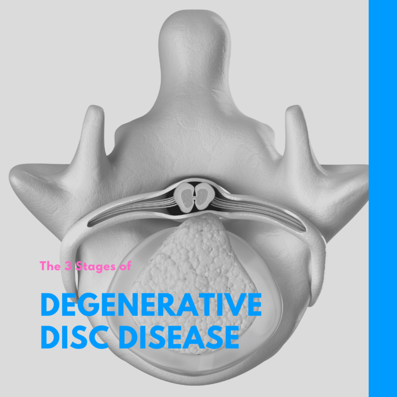 The 3 Stages of Degenerative Disc Disease
