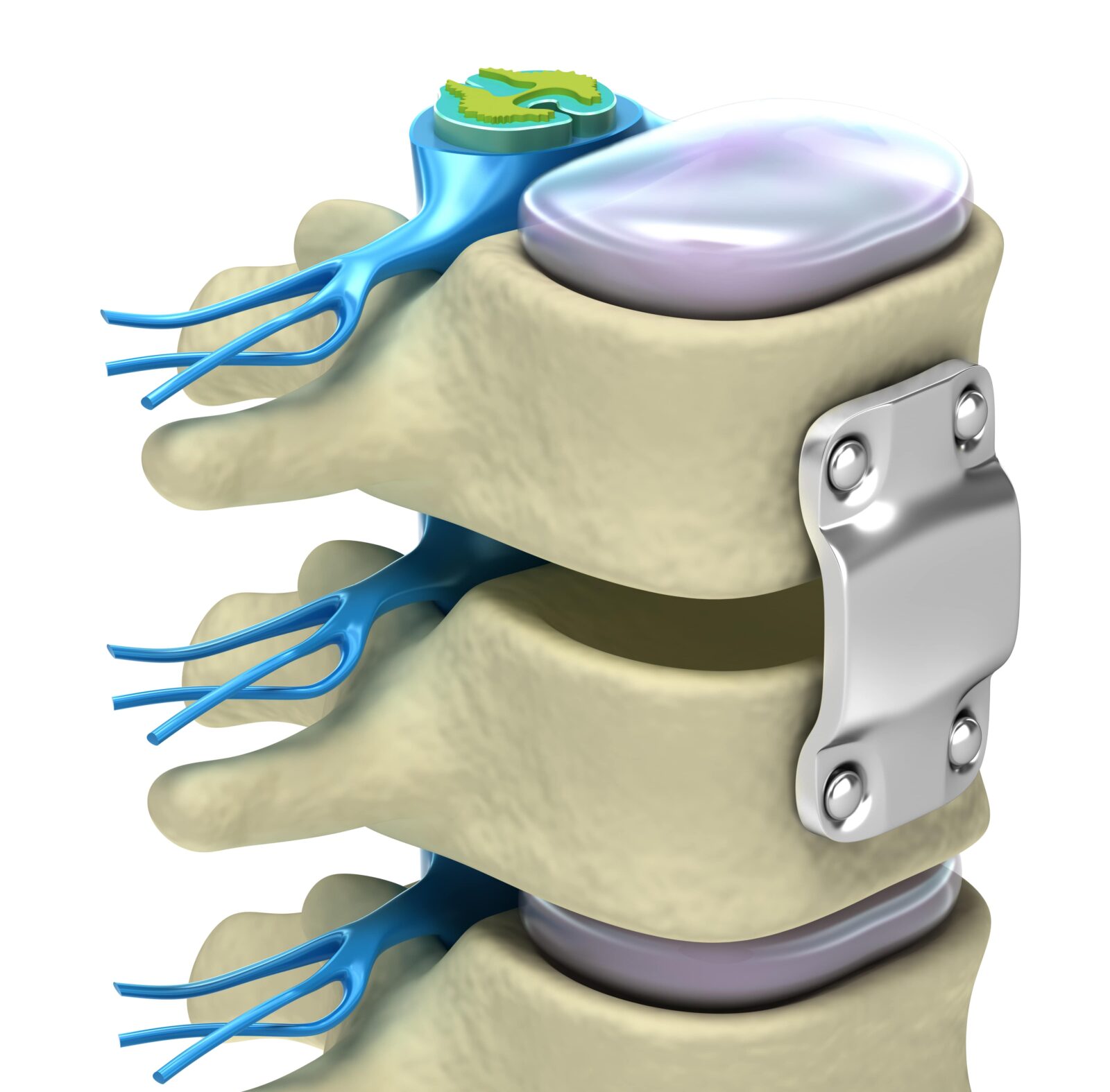 metal plate in a fused spine