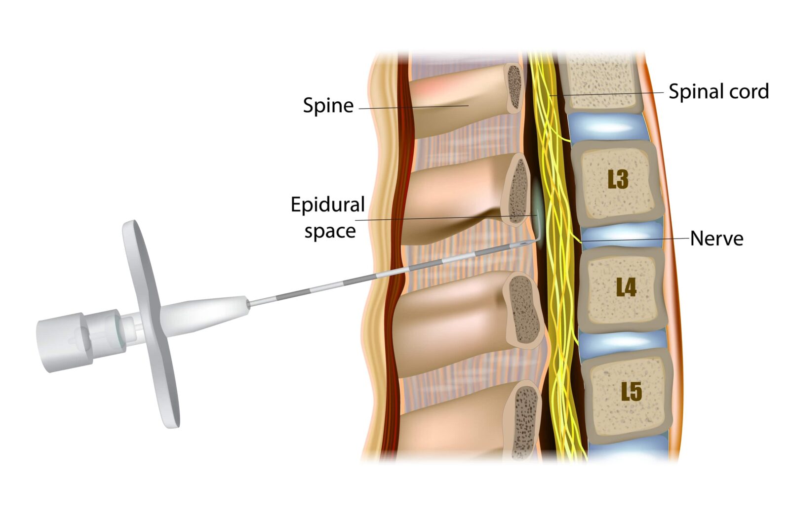 injection into the epidural space