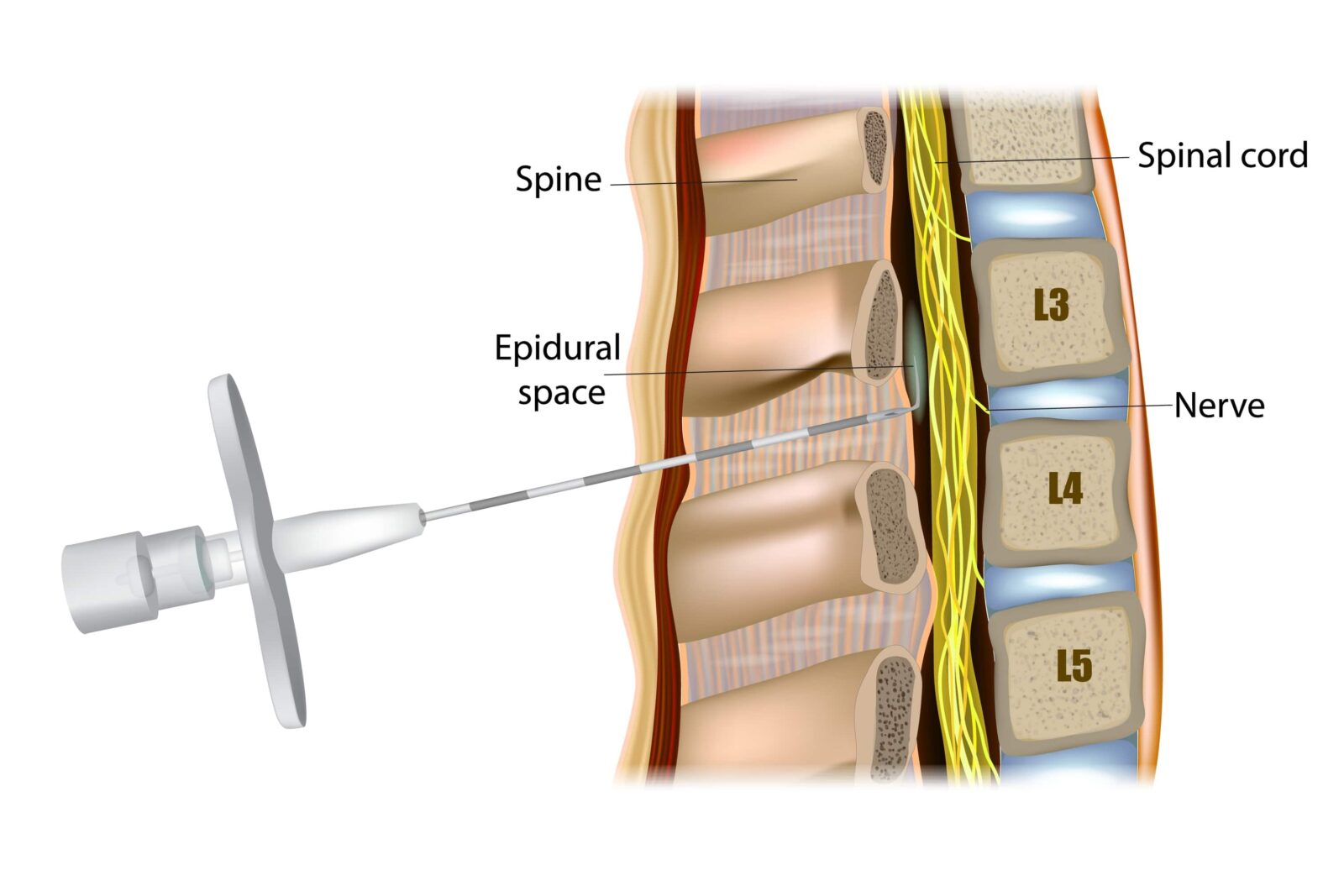 spinal injection