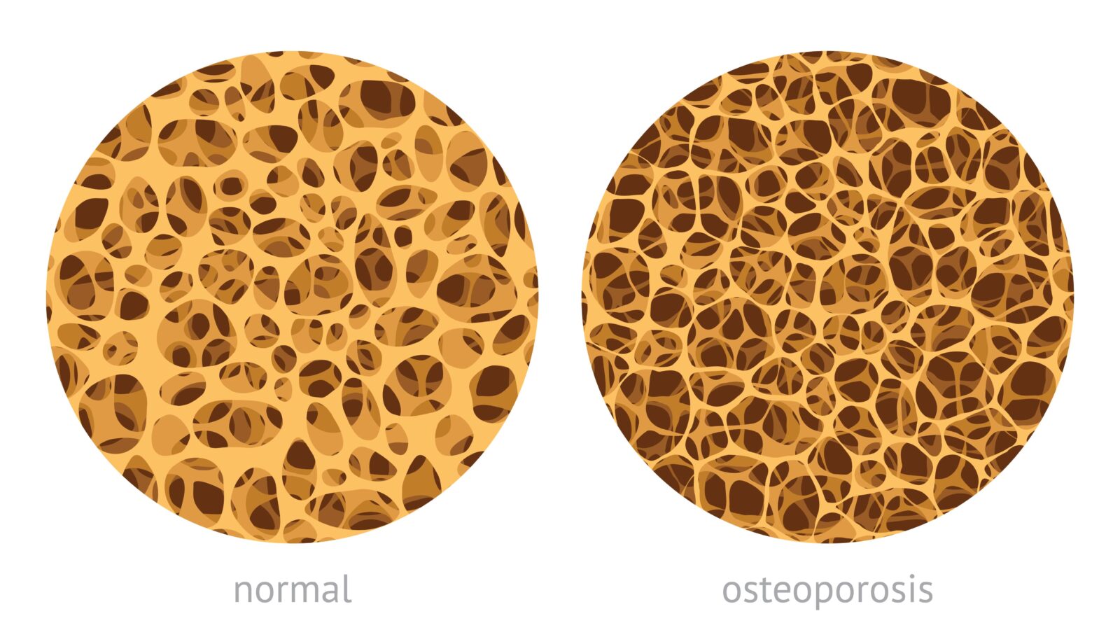normal bone vs. osteoporosis