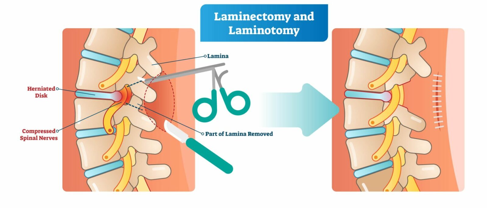 laminotomy vs. laminectomy
