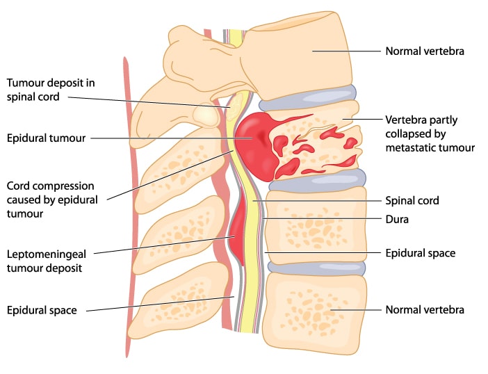 spinal tumor