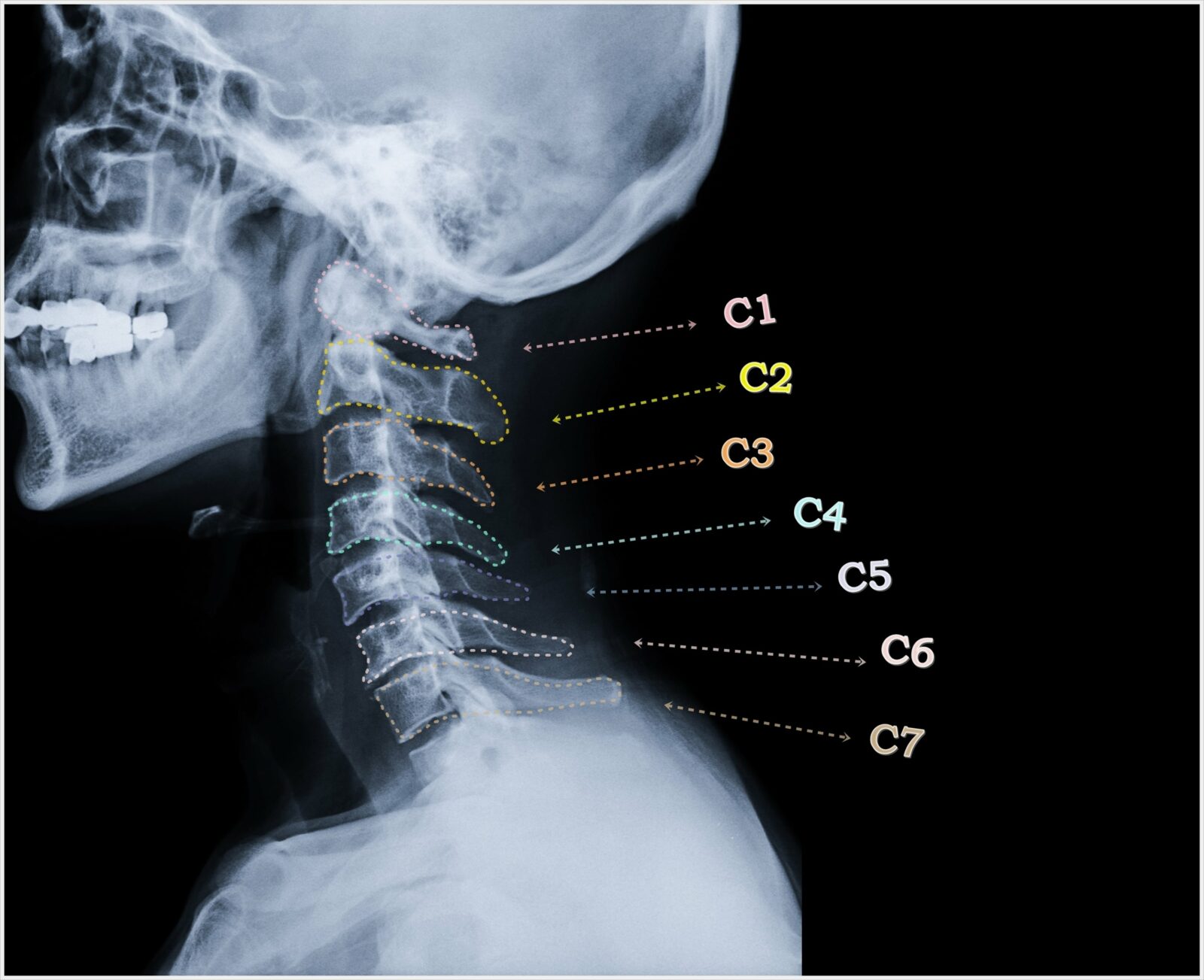 x-ray view of cervical spine
