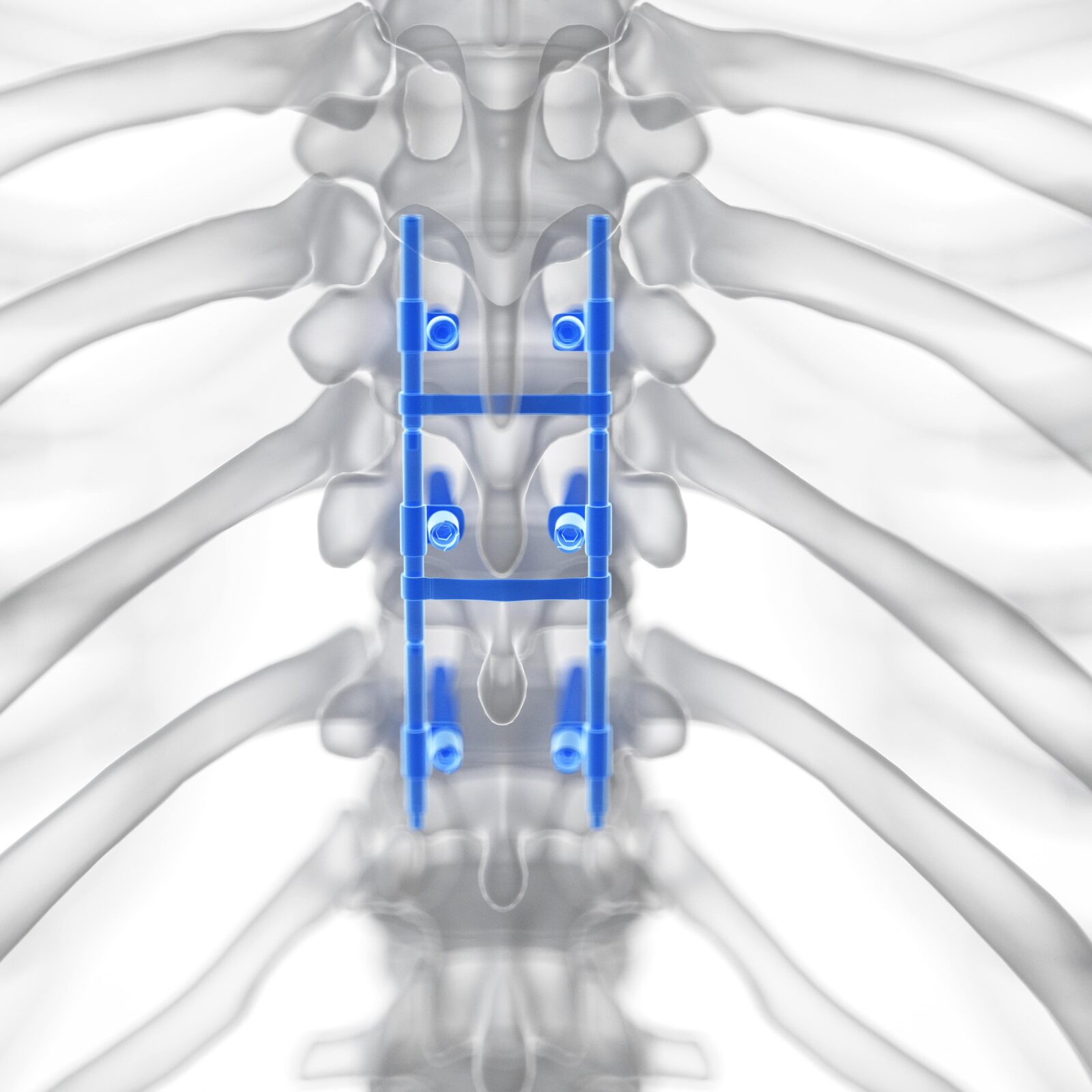 spinal fusion 