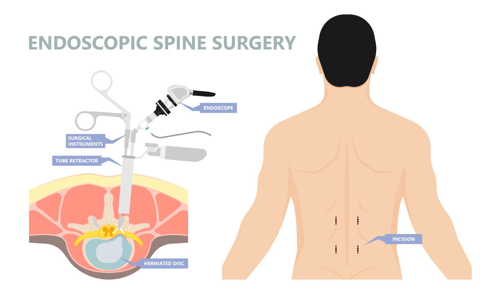 minimally invasive spine surgery