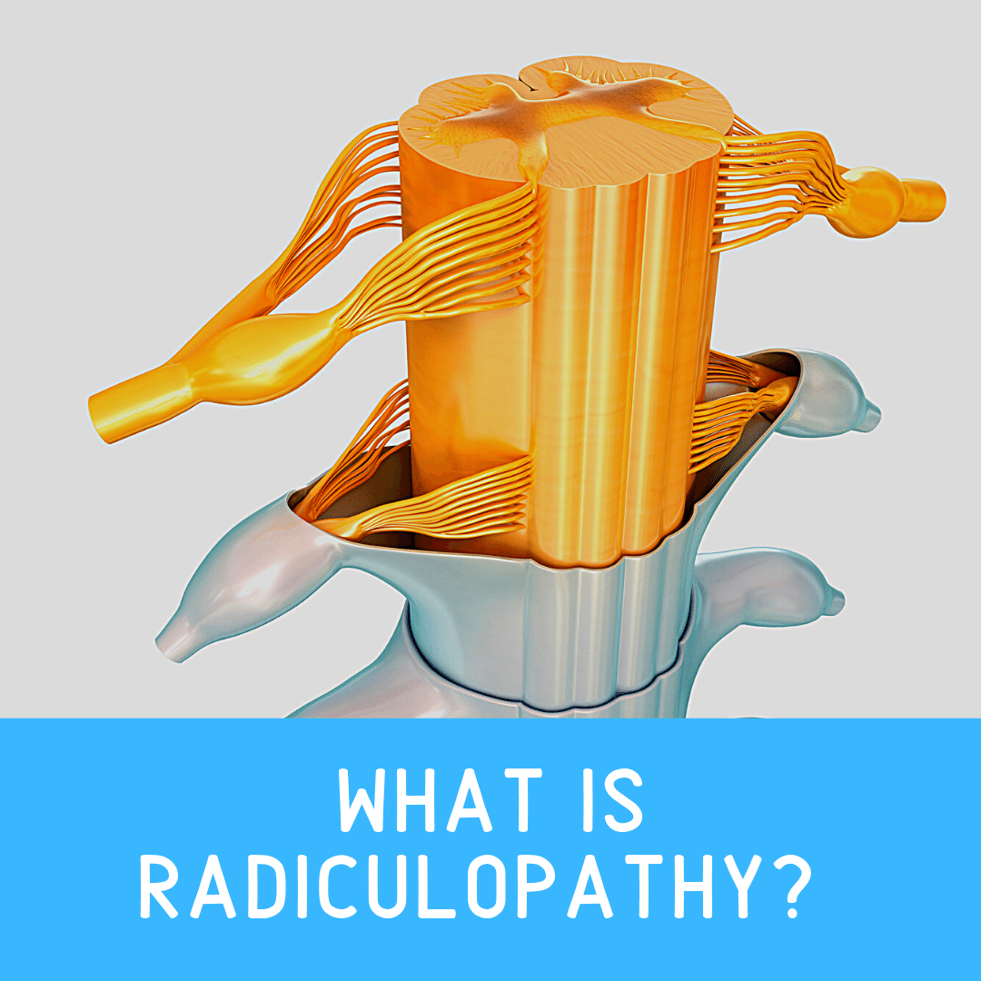 What is Radiculopathy