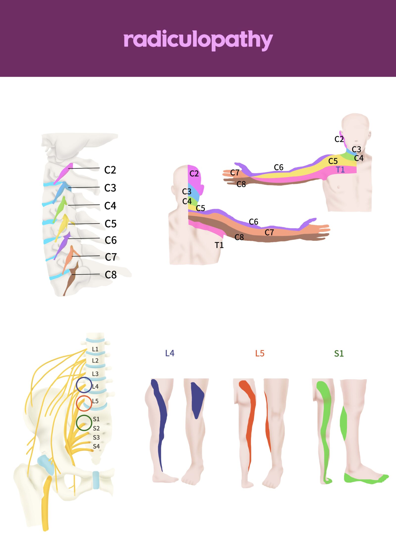 radiculopathy