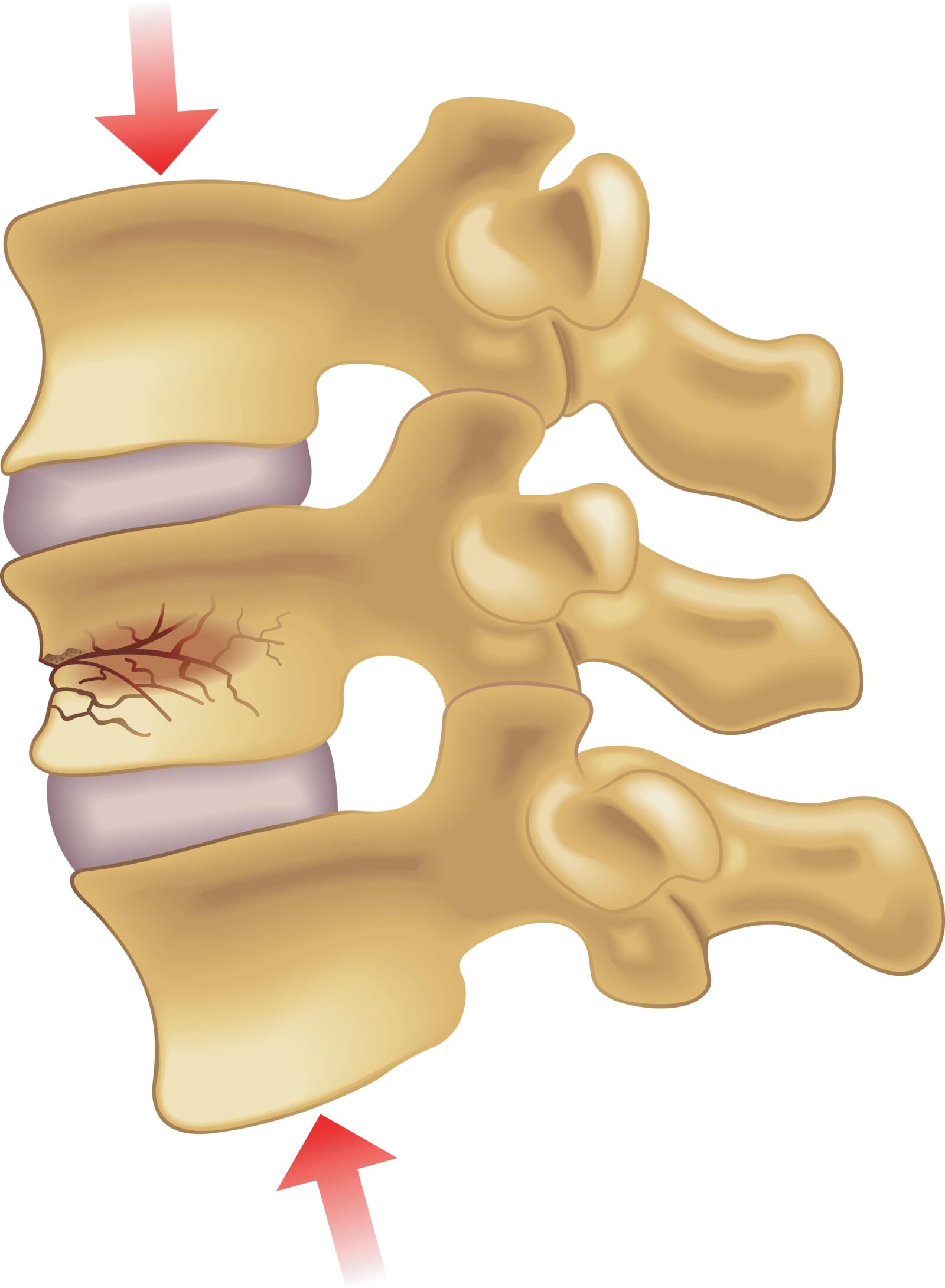 compression fracture spine