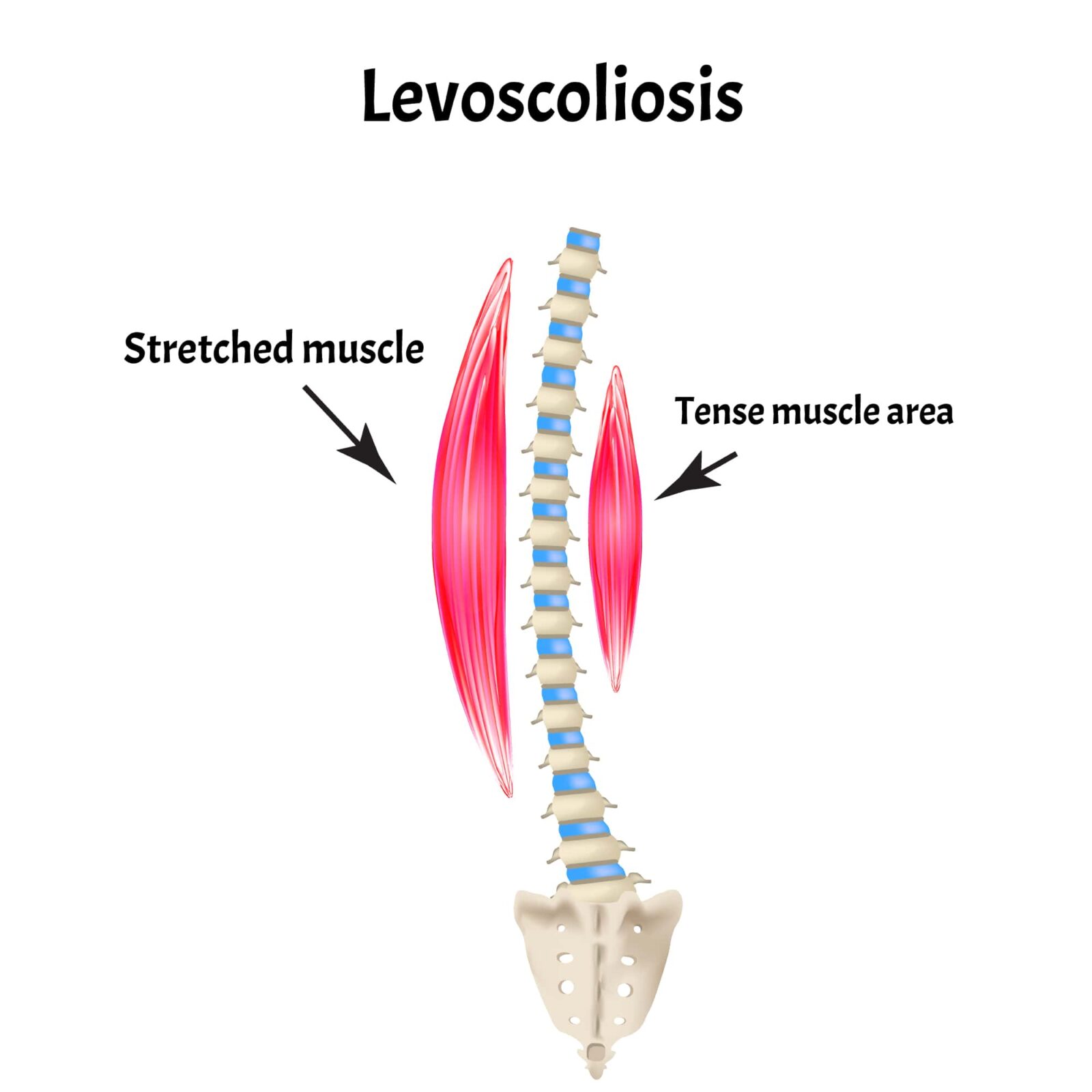 Levoscoliosis
