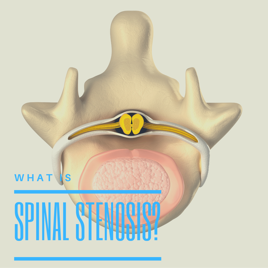 What is spinal stenosis