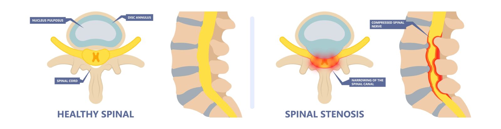 healthy spine vs spinal stenosis