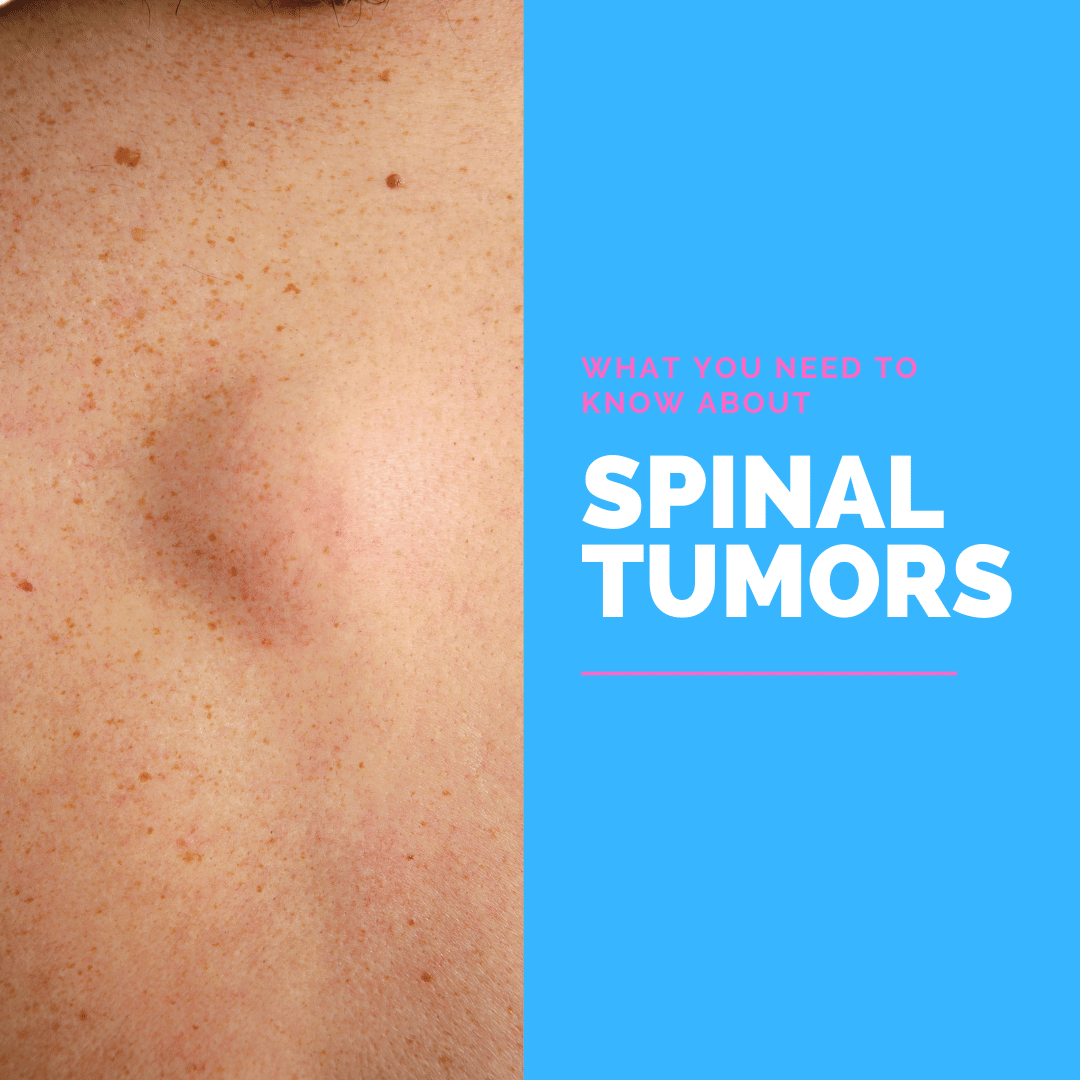 What You Need to Know About spinal tumors