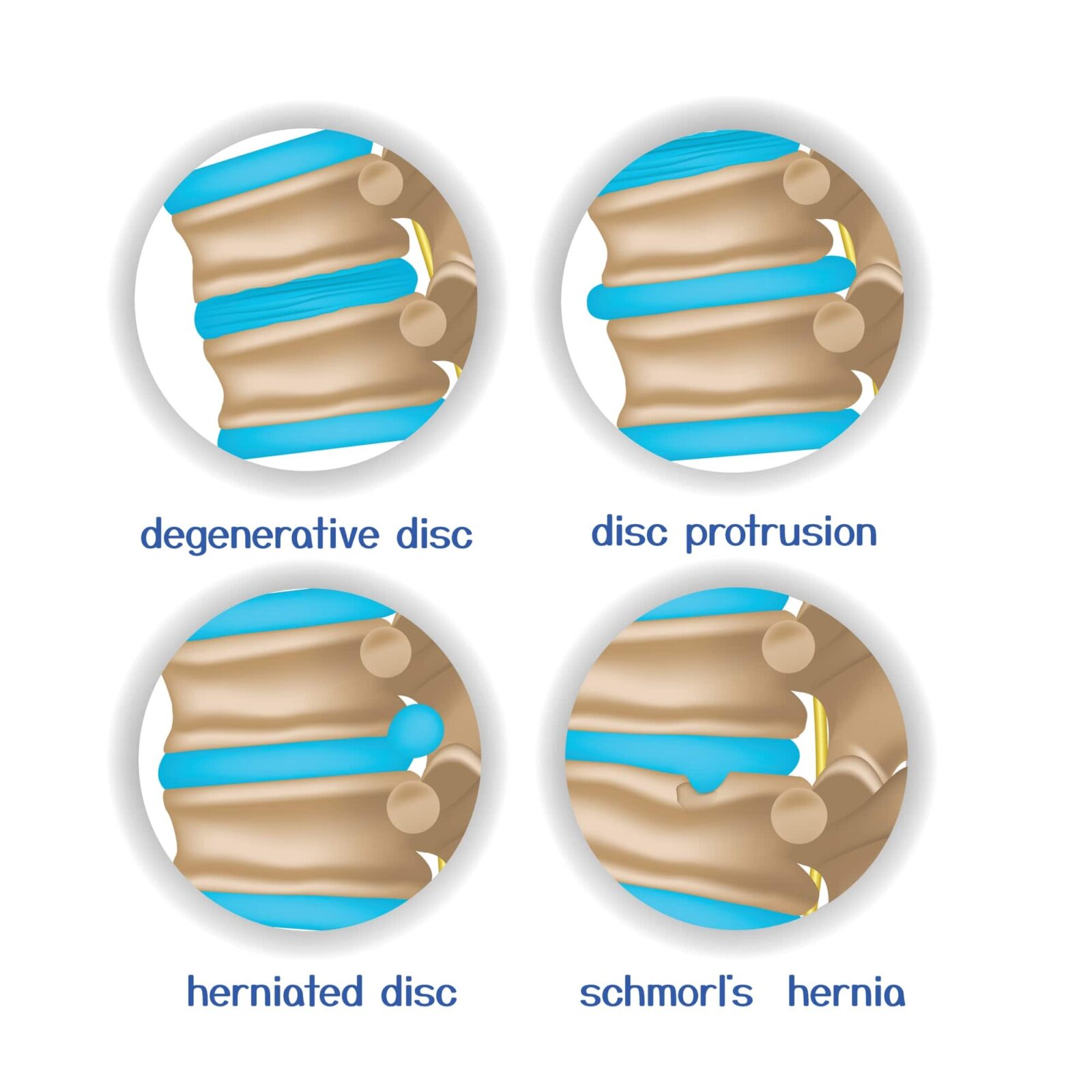 degenerative disc, disc protrusion, herniated disc, schmorl's hernia