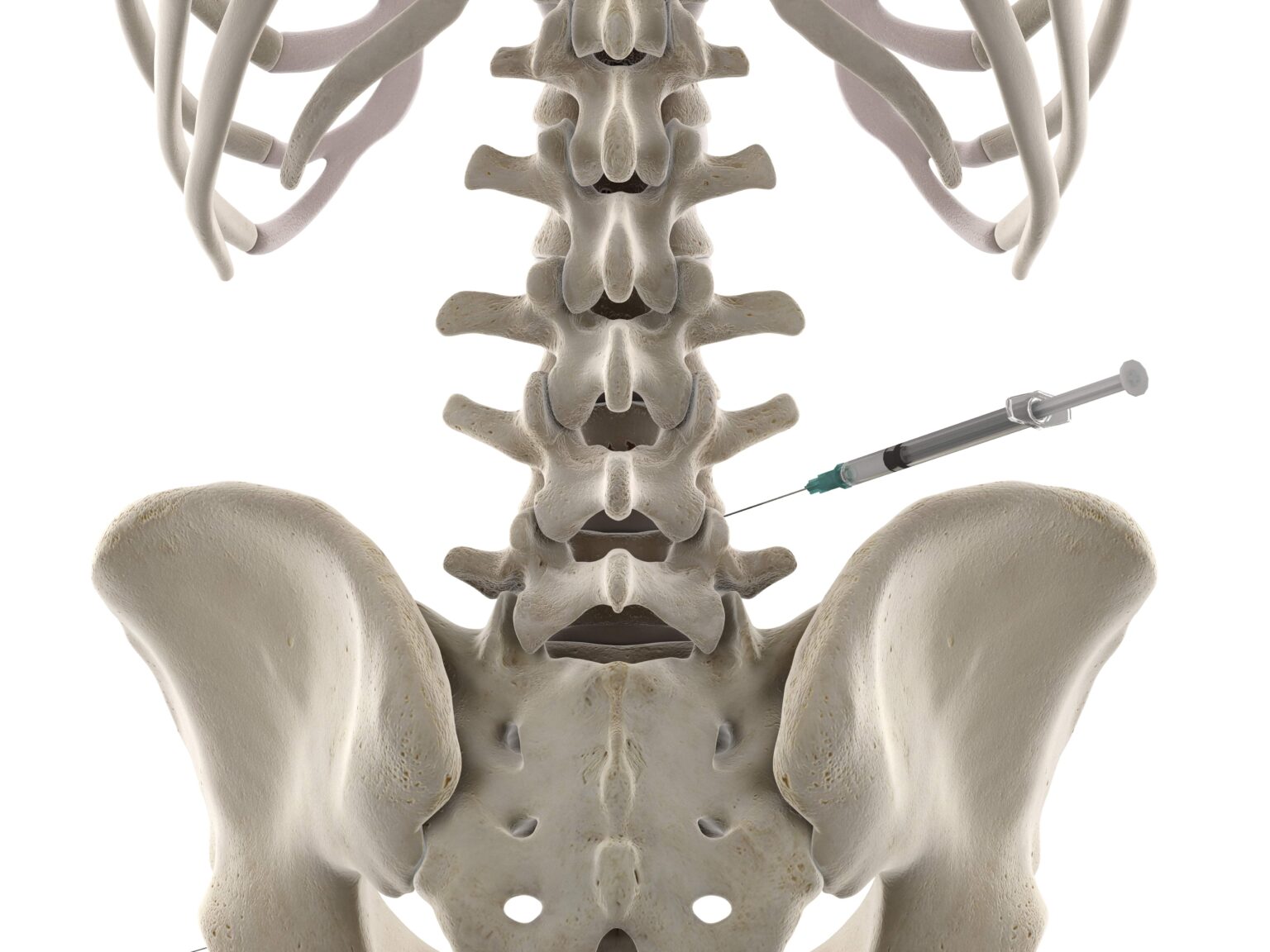 Back Disc Injections What Is An Intradiscal Injection? | New Jersey | Comprehensive Spine Care
