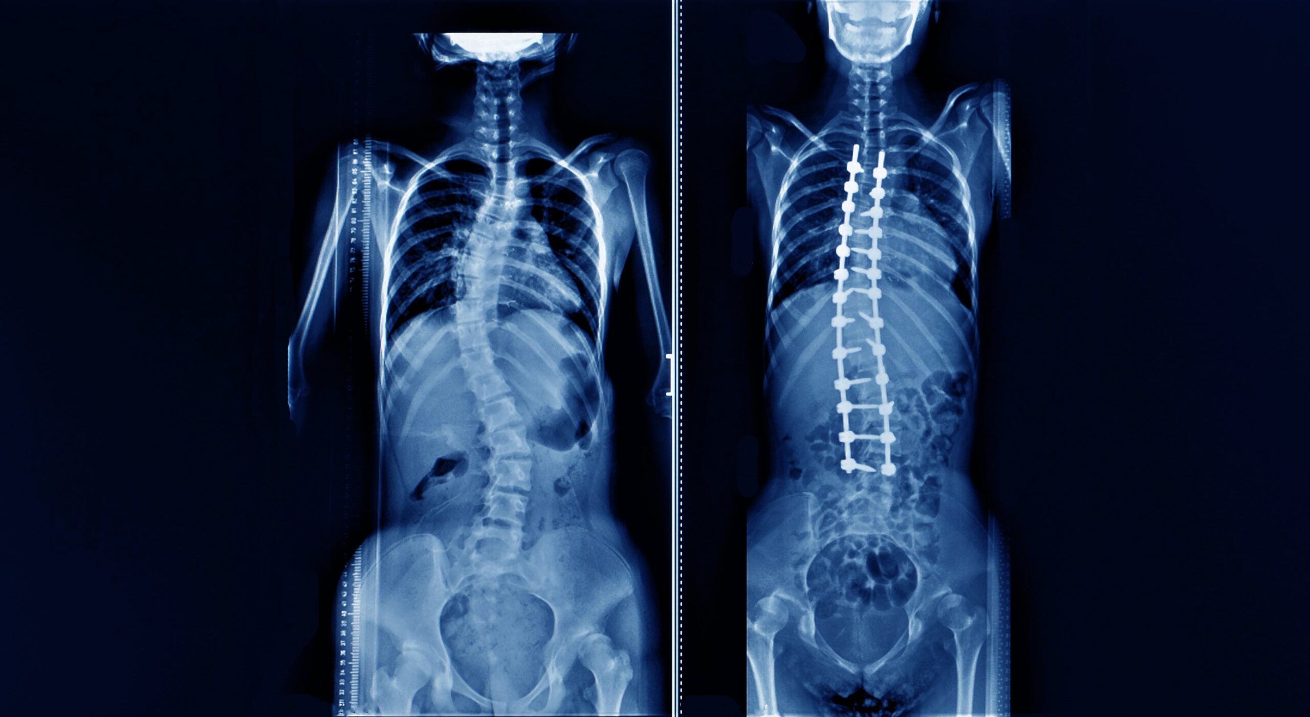 whole spine x-ray showing a patient with adolescent idiopathic scoliosis or AIS before and after correction deformity surgery.