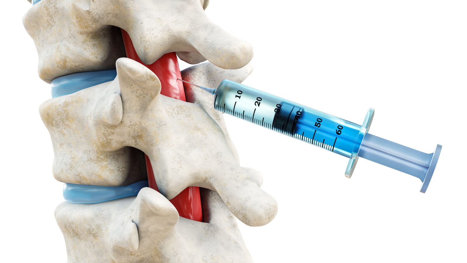 Syringe in the spinal cord isolated on a white background. Backbone or spinal column treatment with epidural injection 3D rendering illustration. Medical and healthcare, anatomy, medicine concept.