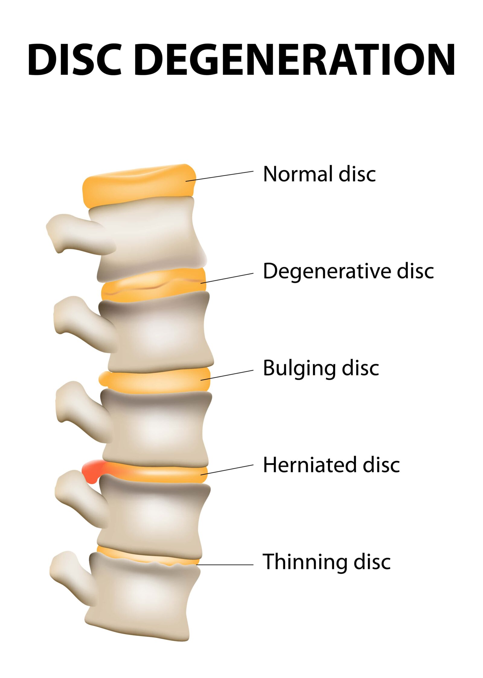 Disc degeneration it's the normal wear and tear process of aging spine. intervertebral discs lose their flexibility, elasticity, and shock-absorbing characteristics.