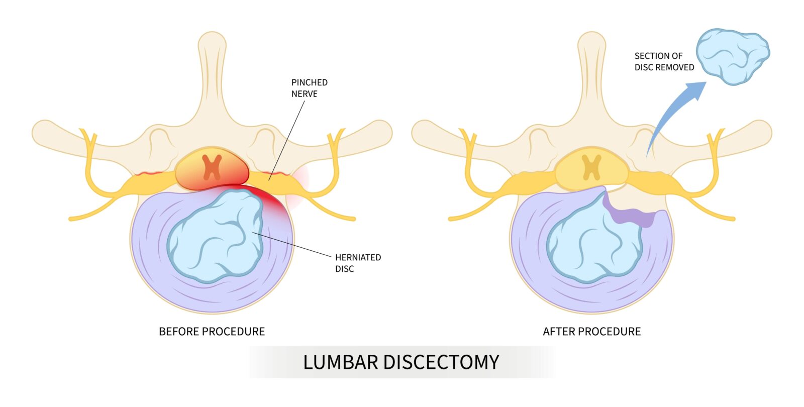 lumbar discectomy