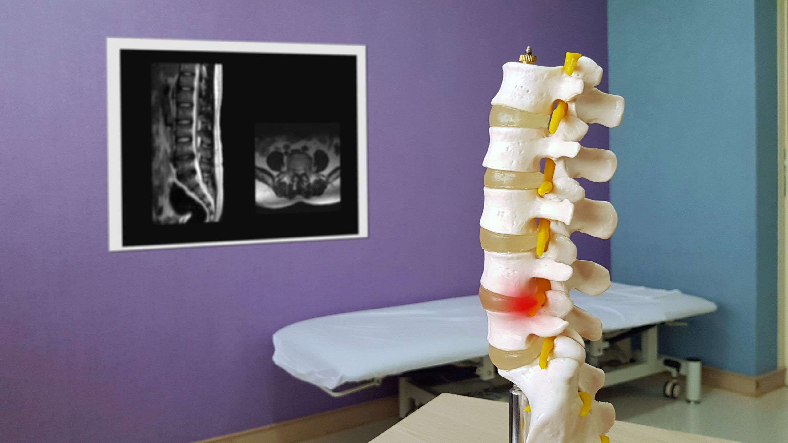 Lumbar spine model show spinal canal stenosis and nerve compression from disc displacement or Herniated disc disease(HNP) with MRI. Medical neurology diagnosis care and treatment technology concept.
