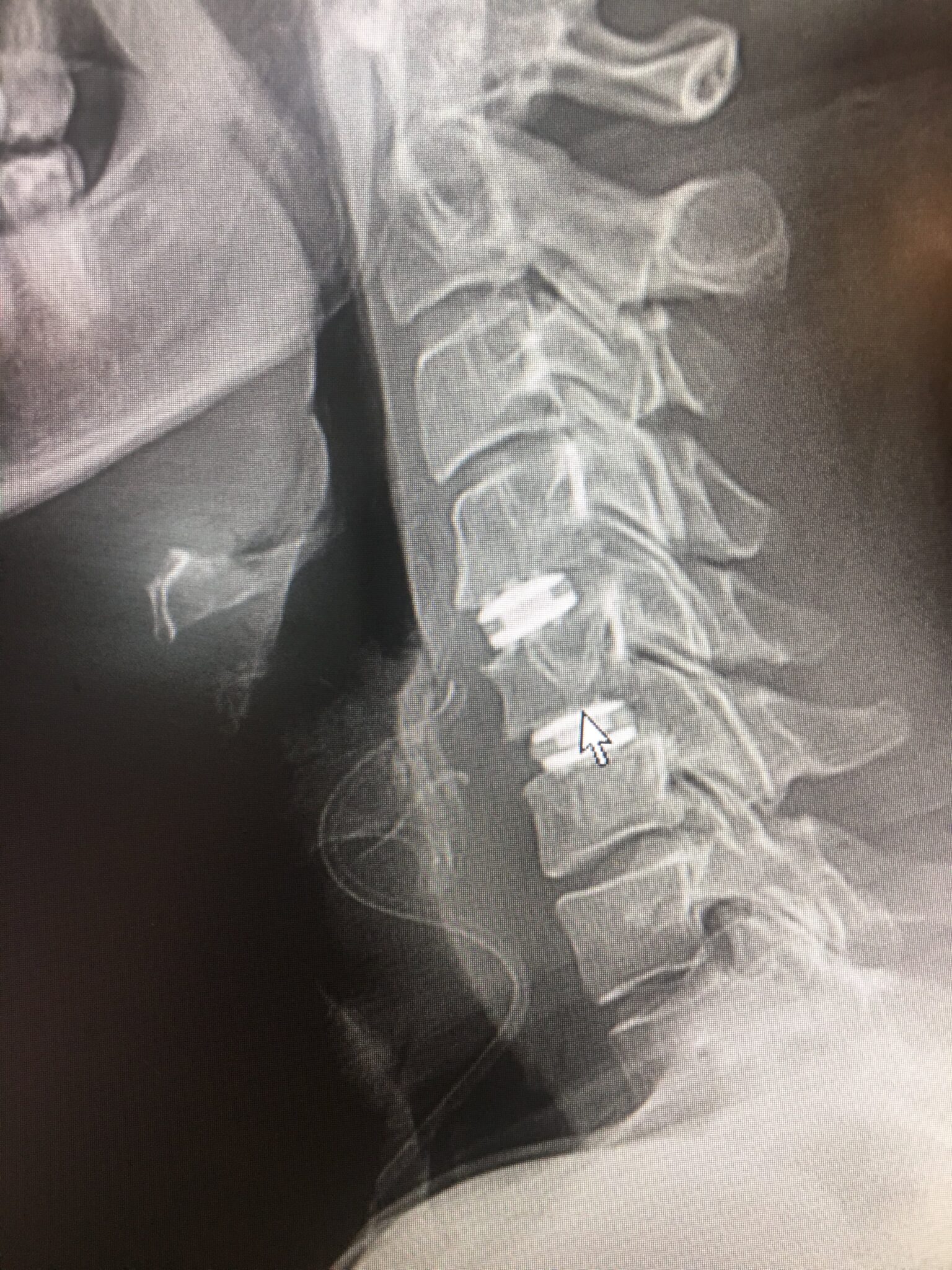 Cervical Artificial Disc Replacement (ADR) Vs. Anterior Cervical ...