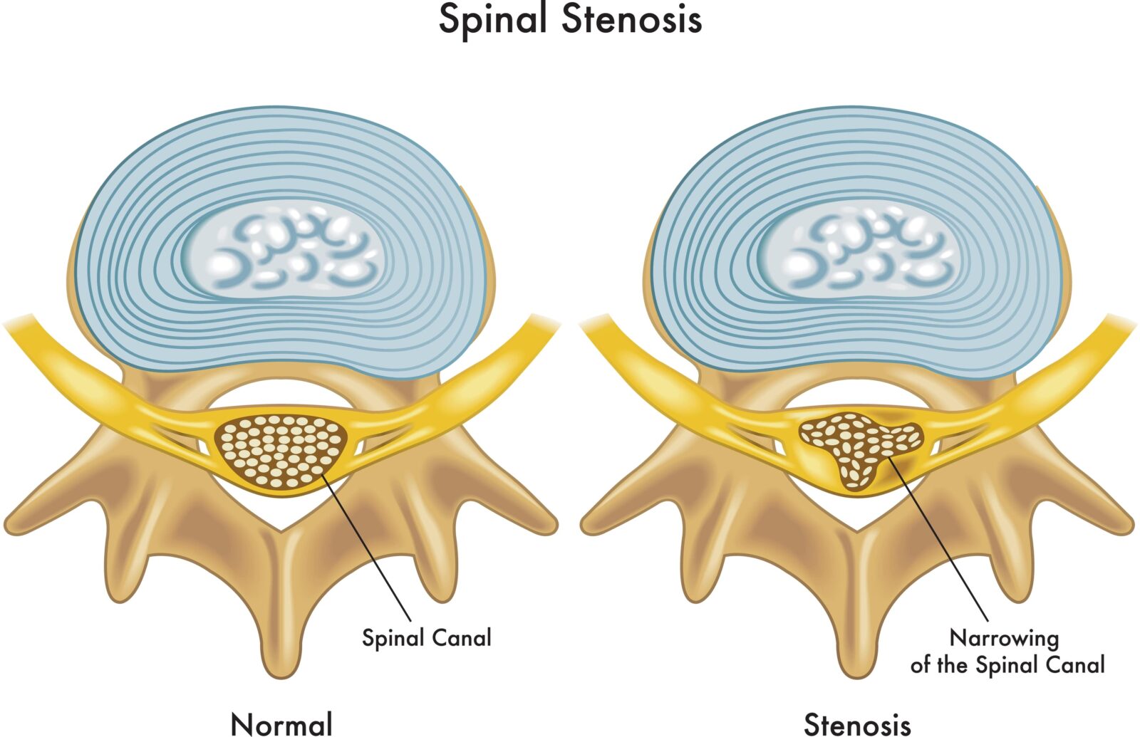 Medical illustration of the consequences of spinal stenosis.