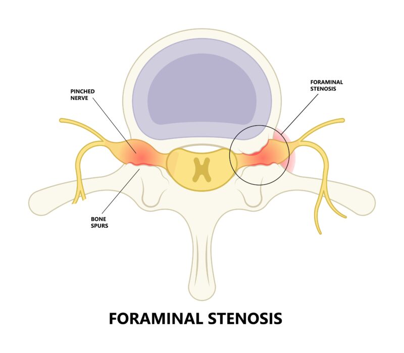 Exploring The Various Types Of Spinal Stenosis: Understanding Symptoms ...