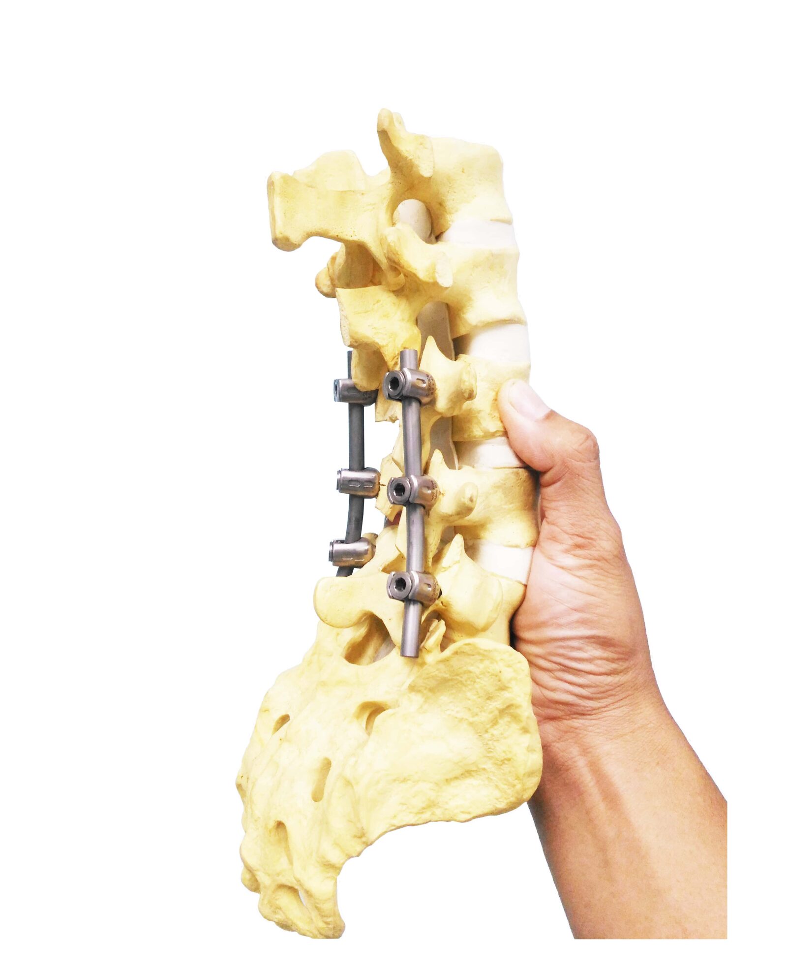 hand holding spinal segment that has been surgically fused with metal rods