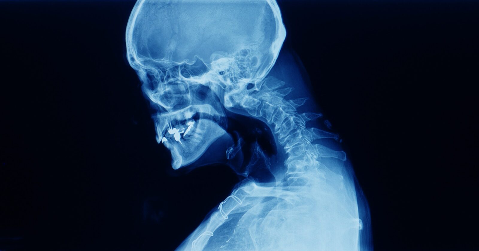 profile x-ray of someone with poor posture