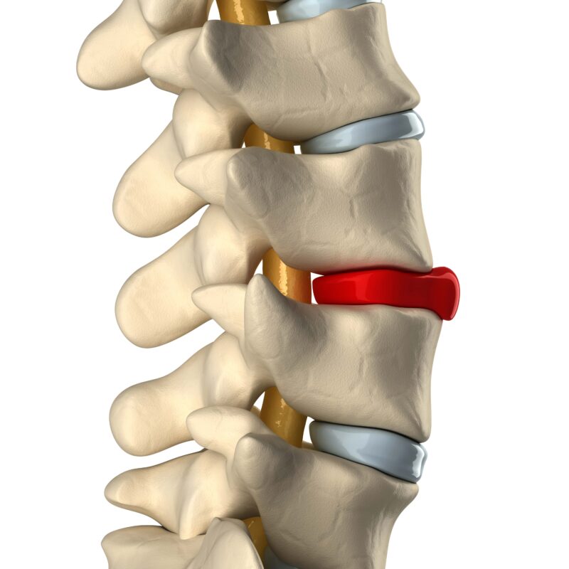 Disc degenerated by osteophyte formation and bulging disc