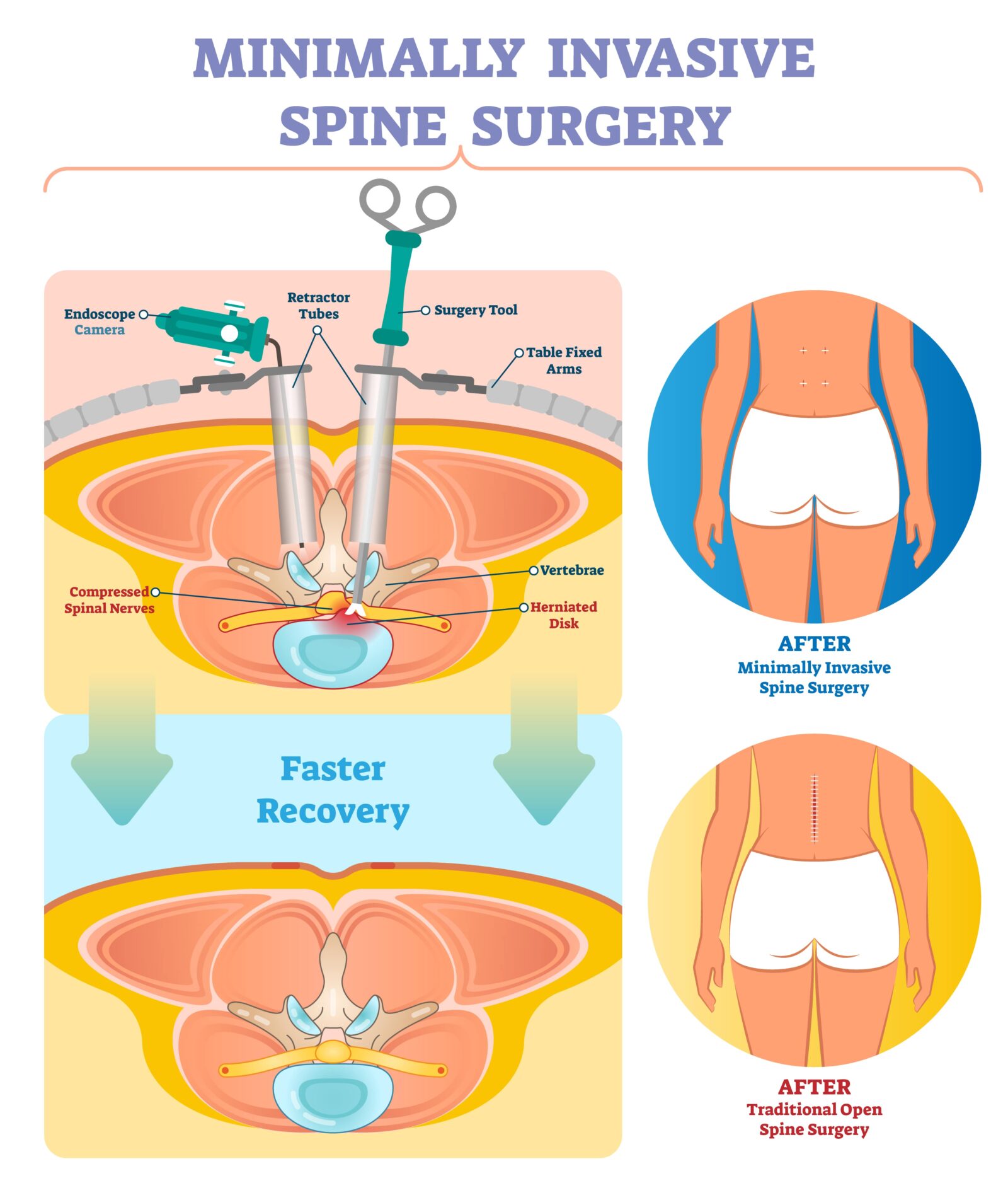 Minimally invasive spine surgery vector illustration. Labeled medical diagram with endoscope camera, retractor tubes, tool, table fixed arms and compressed spinal nerves.